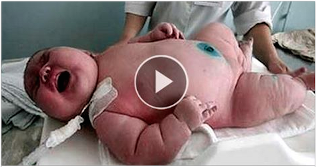 Australia: A Woman of 272 kg Calves A Child of 18 kg, Unbelievable !!!